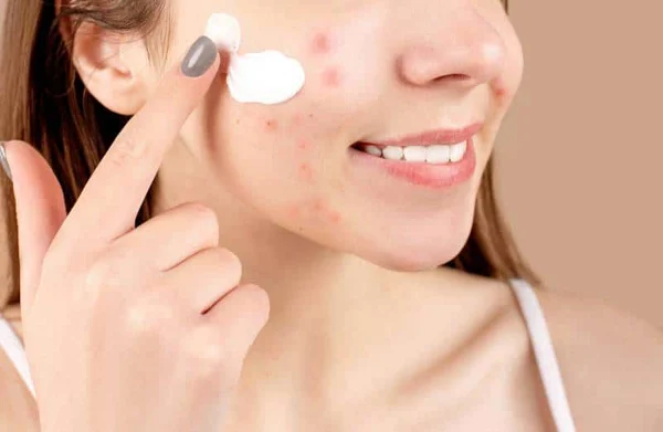 bi-quyet-skincare-cho-da-dau-mun-hieu-qua