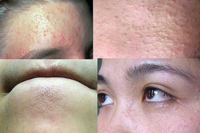 Mụn Ẩn Dưới 