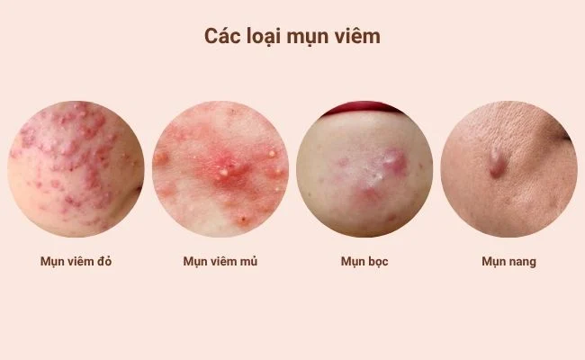 Mụn Viêm
