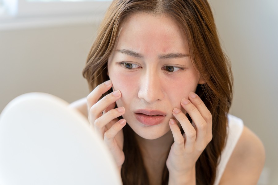 Peel Da Bị Đỏ Rát Và Quy Trình Phục Hồi Cấp Tốc