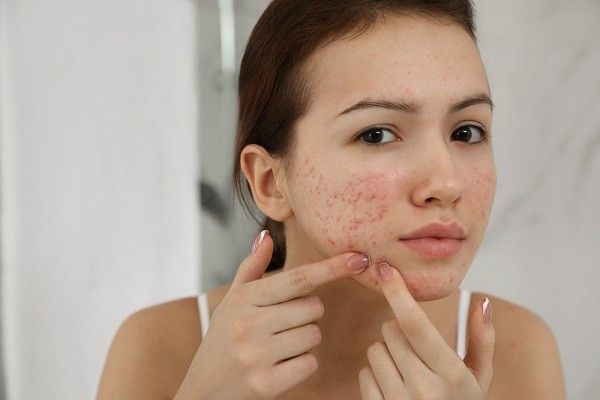 Skincare Trị Mụn Ẩn, Mụn Bọc Mùa Hè Hiệu Quả Cho Da