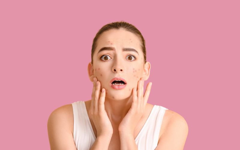 Skincare Trị Mụn Ẩn, Mụn Bọc Mùa Hè Hiệu Quả Cho Da