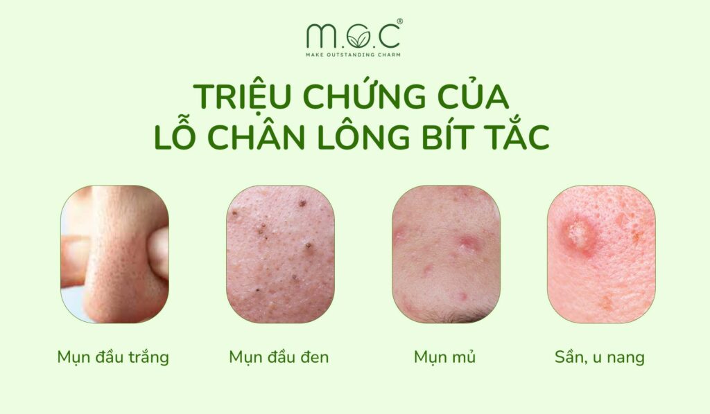 Triệu Chứng Lỗ Chân Lông Bít Tắc