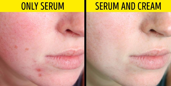 Mẹo Chọn Serum Trị Mụn Cho Da Dầu Mụn Chuẩn Y Khoa
